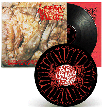 LYMPHATIC PHLEGM \"Malignant cancerous tumour in the...\"