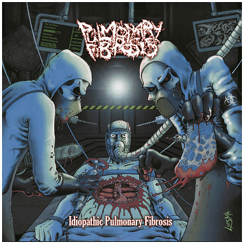 PULMONARY FIBROSIS \"Idiopathic pulmonary fibrosis\"